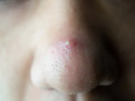 Gros plan sur un nez avec un point noir douloureux et enflammé, entouré de pores visibles.