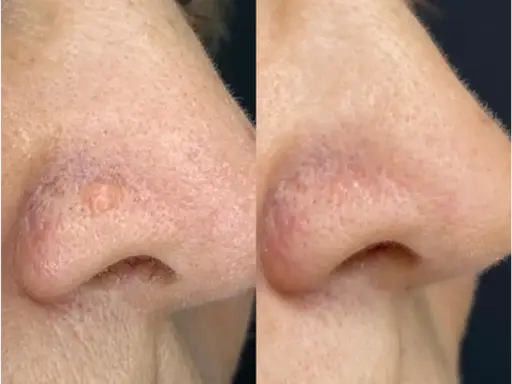 Comparaison avant/après traitement d'une papule fibreuse du nez. La lésion a disparu.