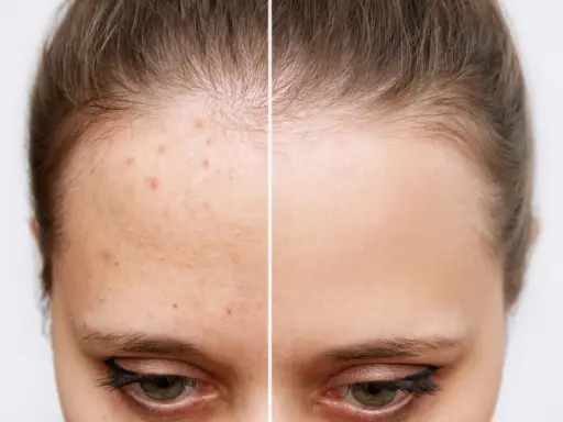 Avant/après : front avec acné et front lisse. L'acide salicylique bienfait pour une peau nette.