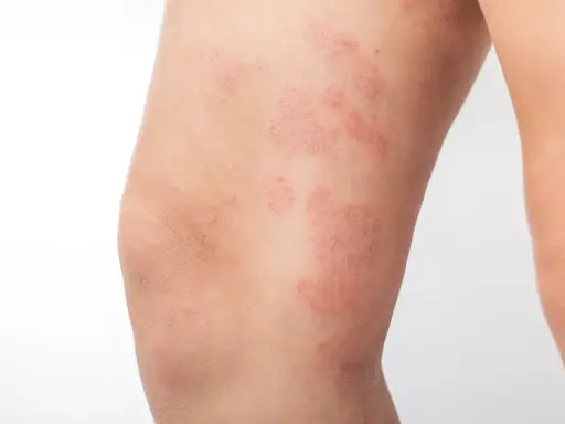 Plaques rouges et squameuses sur la jambe, caractéristiques de l'eczéma nummulaire.