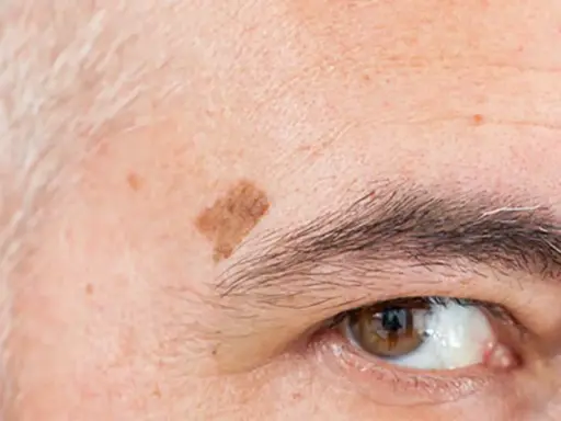 Gros plan sur un œil et un sourcil, avec une tache vieillesse brune sur le front.