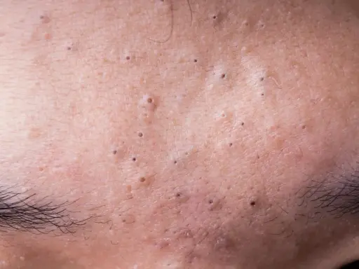 Gros plan sur la peau du front, révélant de minuscules boutons et des pores dilatés, avec des sourcils foncés en bas.