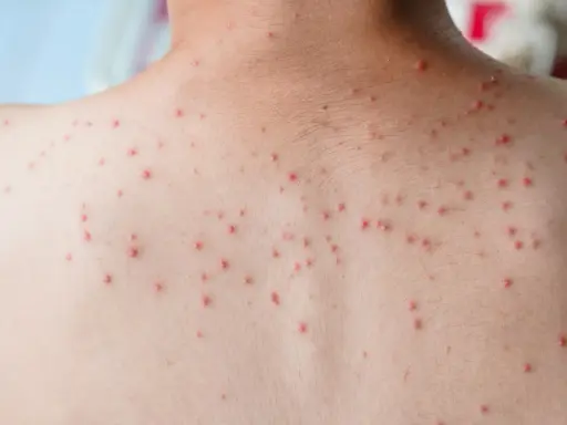 Vue rapprochée du dos d'une personne couverte de petits boutons rouges, possiblement dus à une infection virale comme la varicelle.