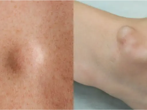 Gros plan sur une peau avec des taches de rousseur et une boule de graisse sous-cutanée sur le bras.
