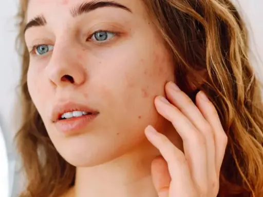 Jeune femme examinant son visage dans un miroir, avec des rougeurs et des imperfections. Comment savoir notre type de peau pour mieux en prendre soin.