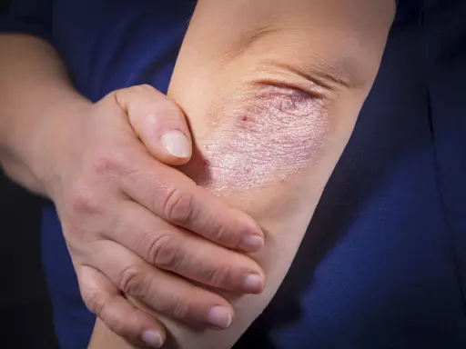Une personne touche son coude, révélant une plaque de psoriasis inversé, rouge et squameuse, sur sa peau.