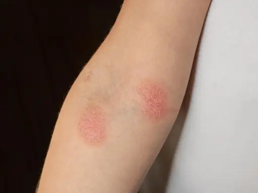 Deux plaques rouges sur un bras, ressemblant à un bouton rouge avec point blanc, indiquent une irritation cutanée.
