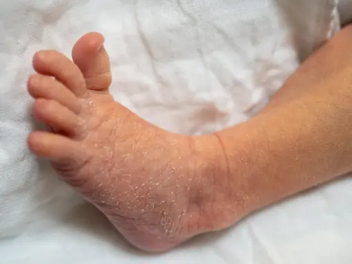Pied de bébé avec peau sèche et squameuse, évoquant le psoriasis bébé.