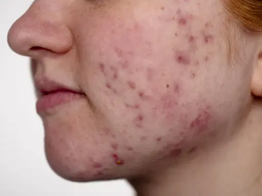 Gros plan sur le visage d'une jeune femme, montrant une peau rougie avec de nombreux comédons et boutons d'acné.