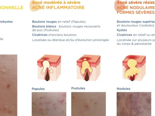 Illustration des différents types d'acné : rétentionnelle, inflammatoire, nodulaire et kystique. Chaque type d'acné est décrit avec ses caractéristiques et représenté par des schémas et des photos.