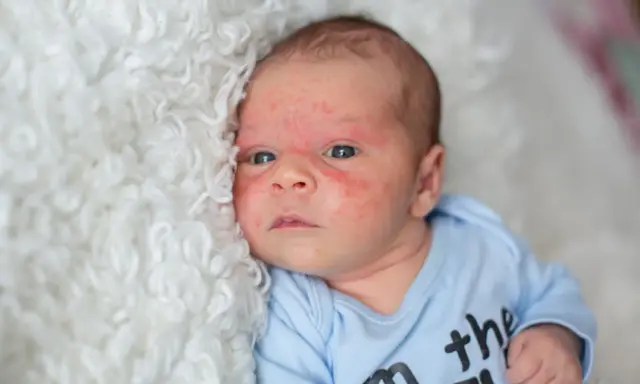 Visage de bébé avec un bouton de lait, sur une couverture blanche et moelleuse.