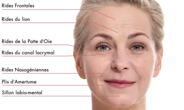 Visage d'une femme montrant les rides du visage signification : frontales, du lion, patte d'oie, canal lacrymal, nasogéniennes, plis d'amertume, sillon labio-mental.