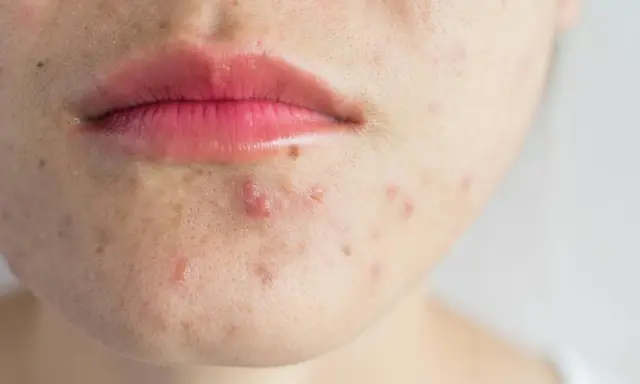 Gros plan sur le bas du visage d'une personne, montrant des imperfections et un bouton sans pu près de la bouche.