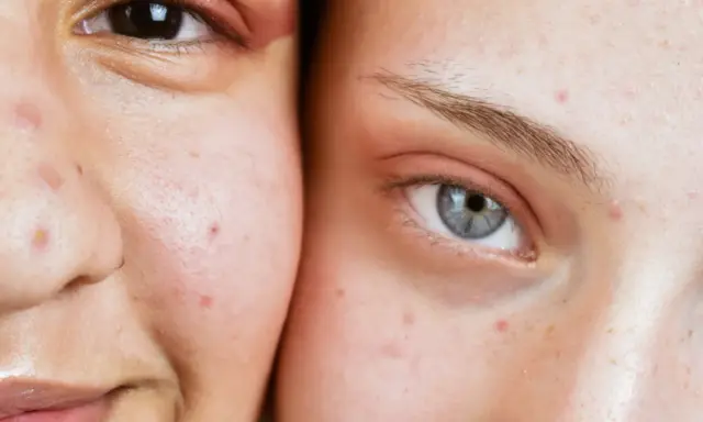 Gros plan sur deux visages, montrant des imperfections cutanées, un bouton stress visible sur la joue de l'une d'elles.