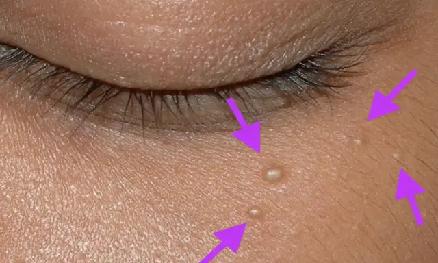 Gros plan sur la peau près de l'œil, montrant plusieurs petits points blancs, des grains de milium percer, indiqués par des flèches violettes.
