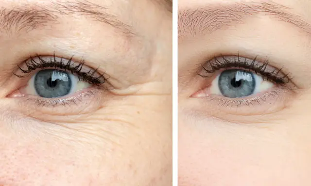 Comparaison avant/après : la peau déshydratée montre des rides marquées autour de l'œil, tandis que la peau hydratée apparaît lisse et repulpée.