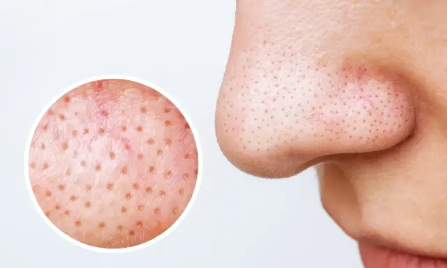 Gros plan sur le nez montrant des filaments sébacés dans les pores. Une loupe révèle la texture de la peau, suggérant des remèdes maison pour les imperfections.