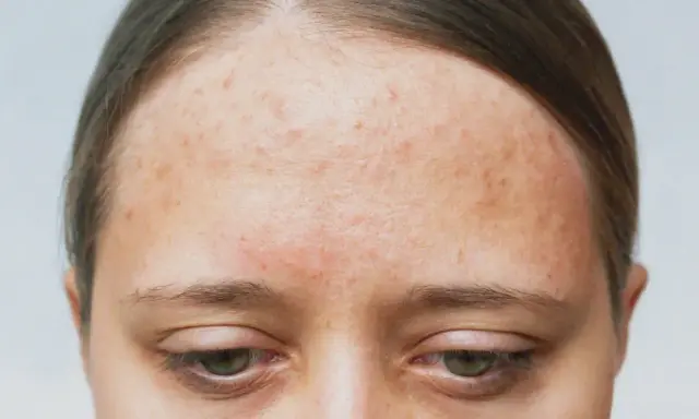 Front de la peau avec des rougeurs et des imperfections, signes d'acné rétentionnelle.