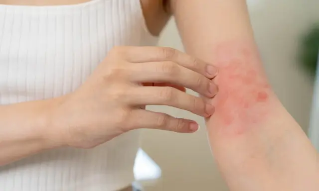 Une personne se gratte le bras, révélant un petit bouton sur les bras allergie, rouge et irrité.