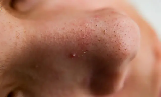 Gros plan sur un nez avec des pores visibles et un bouton avec point noir au milieu.