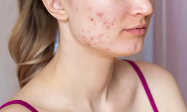 Visage d'une jeune femme montrant des rougeurs et des boutons, signes d'acné inflammatoire.