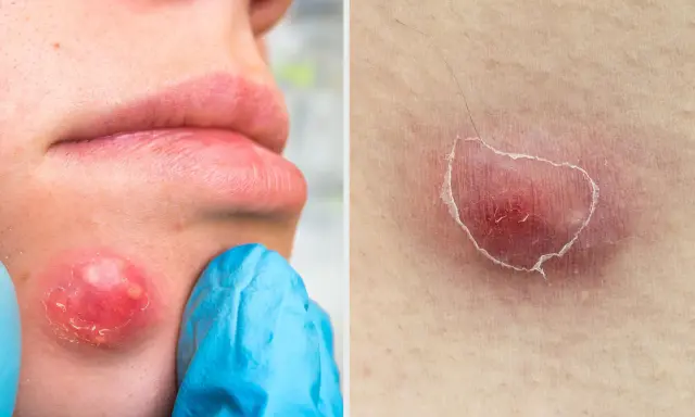 Gros bouton blanc sur la joue, examiné par une main gantée de bleu. Un autre bouton rouge et enflammé sur la peau.
