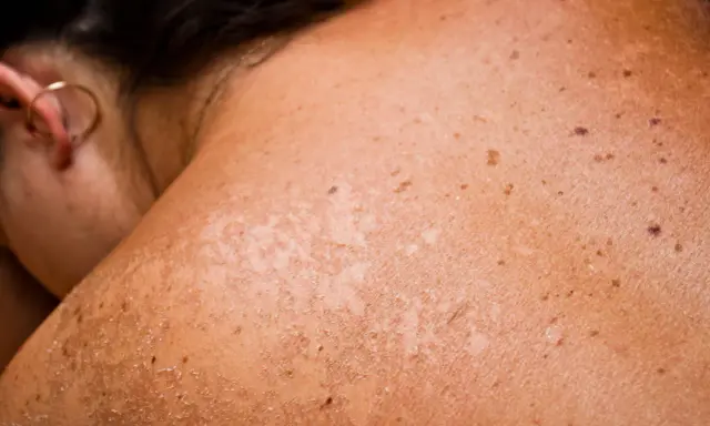 Gros plan sur une épaule et un cou montrant une peau bronzée avec des taches brunes et des zones de peau qui pèle, signe d'un coup de soleil.