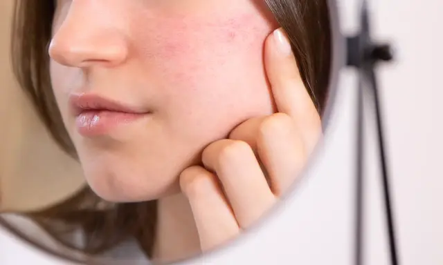 Une jeune femme examine son visage rouge, peut-être à cause de l'alcool, dans un miroir.