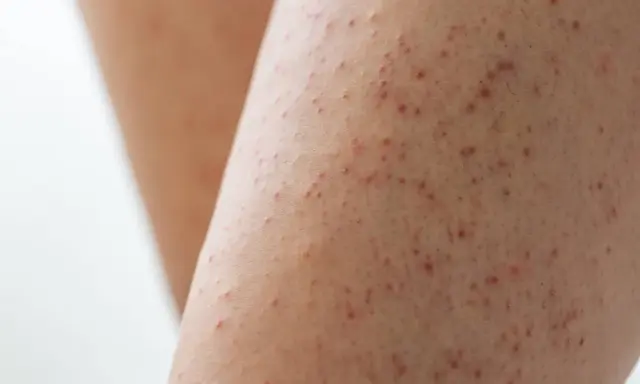 Gros plan sur une peau présentant de petites rougeurs et aspérités, signe d'un excès de kératine peau.