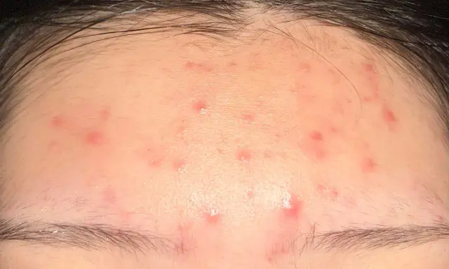 Plusieurs petits boutons rouges parsèment le front, sous la ligne des cheveux.