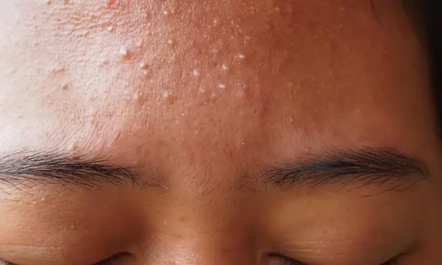 Gros plan sur le front d'une personne avec de nombreux petits boutons blancs, signe d'une peau à imperfections.
