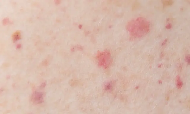 Gros plan sur une peau présentant des pétéchies et des signes de vieillissement cutané, avec des taches rouges et des irrégularités de texture.