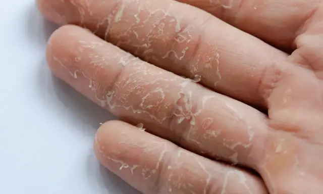 Gros plan sur des doigts dont la peau pèle sans raison, révélant une texture sèche et squameuse.