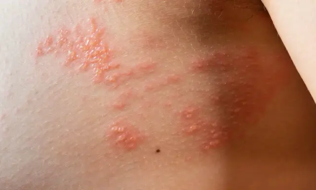 Peau irritée avec un petit bouton cloque qui gratte, formant des grappes rouges et enflammées.