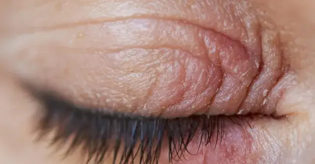 Gros plan sur un œil fermé, montrant des paupières sèches et irritées avec des ridules et des squames.