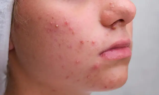 Gros plan sur un visage avec de nombreux boutons blancs et rouges, signe d'une peau à problèmes.
