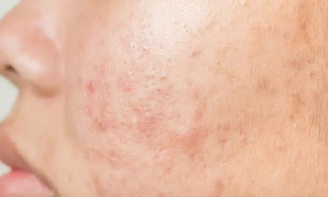 Gros plan sur la peau d'un adulte présentant des rougeurs et des marques, typiques d'un bouton visage adulte.