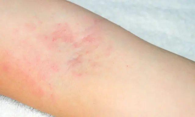 Début d'eczéma sur le bras, avec des plaques rouges et irritées sur la peau claire.