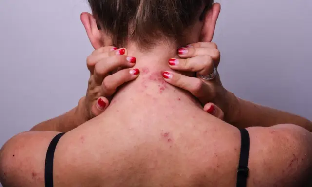 Une personne se gratte le cou et l'épaule, révélant des rougeurs et des irritations dues à l'eczéma.