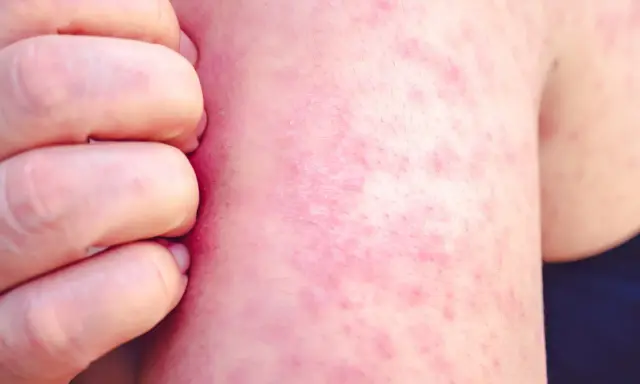 Une peau rougie et irritée, recouverte de petits boutons de chaleur, est grattée par des doigts.