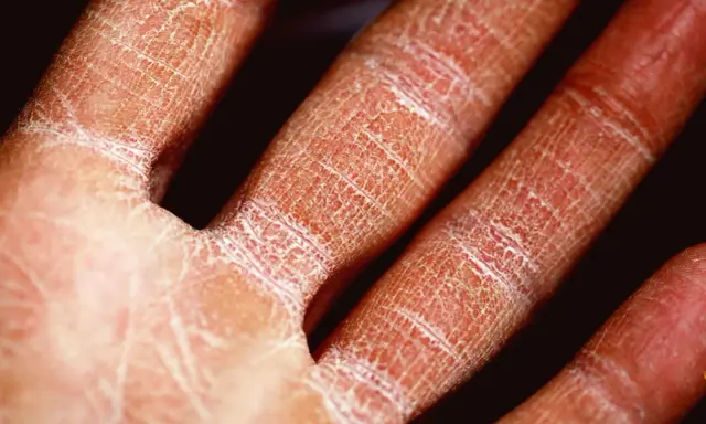 Main sévèrement atteinte par l'eczéma, la peau est rouge, sèche et craquelée, formant un réseau de fines lignes blanches.