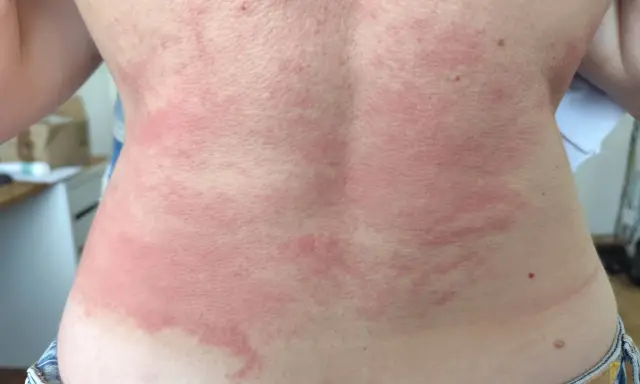 Le dos présente des plaques rouges et irritées, typiques d'un **eczéma peau**. La zone affectée est étendue, allant du cou jusqu'à la taille.