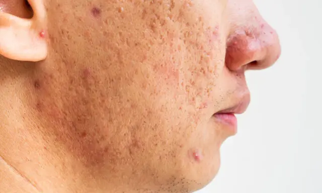 Gros plan sur le visage d'une personne montrant des cicatrices et des rougeurs dues à une acné sévère.