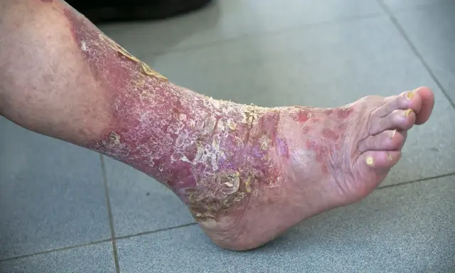 Psoriasis palmo plantaire sévère sur la jambe et le pied, avec peau rouge, squameuse et craquelée.