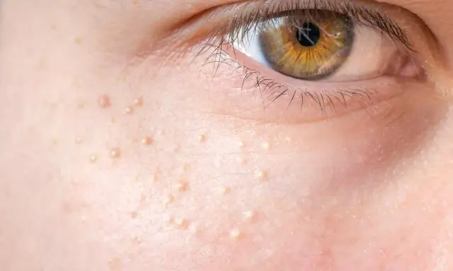 Gros plan sur la peau d'un œil, parsemée de petits points blancs, des grains de milium, qui ressemblent à de minuscules perles incrustées.