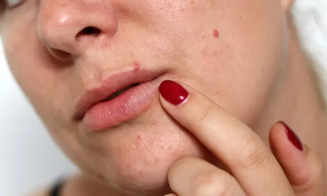Un doigt avec un ongle rouge touche un petit bouton acné lèvre.