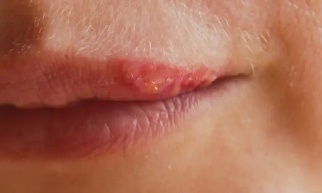 Lèvres rouges et irritées, signe d'un herpes labial que faire pour soulager ?