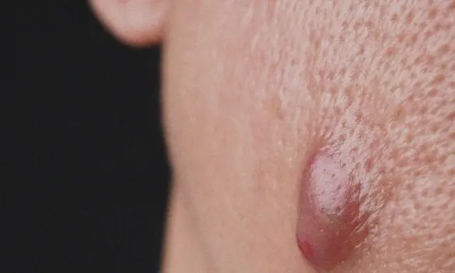 Gros plan sur une peau présentant des pores dilatés et une lésion inflammatoire typique de l'acné conglobata.