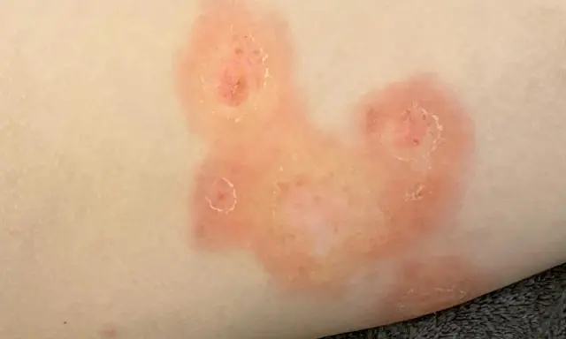 Plaques rouges et squameuses sur la peau, évoquant une mycose fessier adulte.
