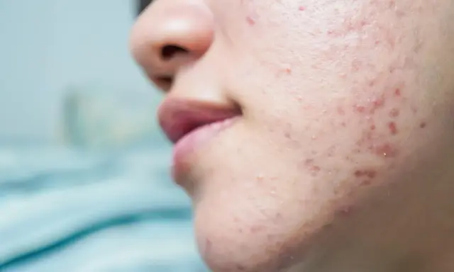 Gros plan sur une peau acnéique, montrant des rougeurs et des imperfections. Ce type d'acné peut être lié à l'effet de la progestérone sur la peau.